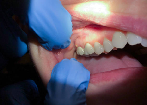 Best Emergency Cosmetic Dentistry (e.g., broken veneers) in Frostburg, MD